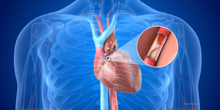 oronary-artery-bypass-surgery