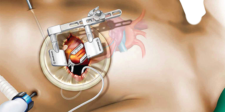minimally-invasive-surgery