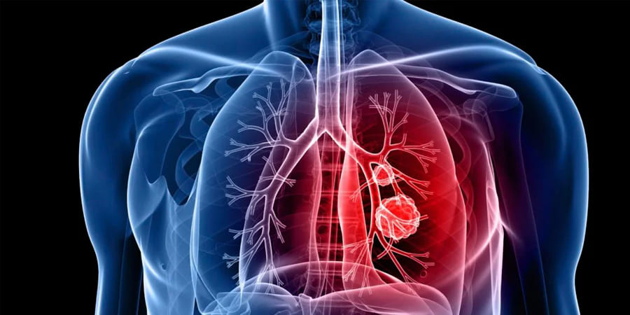 thoracic-surgery